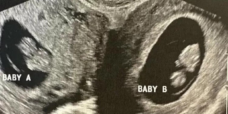 Žena sa dvije materice zatrudnila u obje