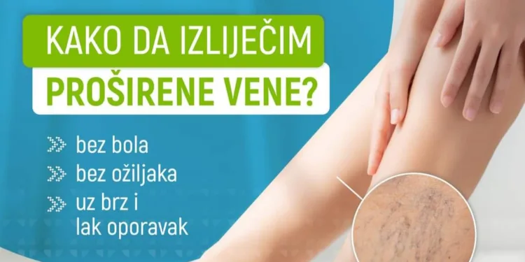 Problem sa proširenim venama? Obratite se banjalučkoj bolnici Medical Group